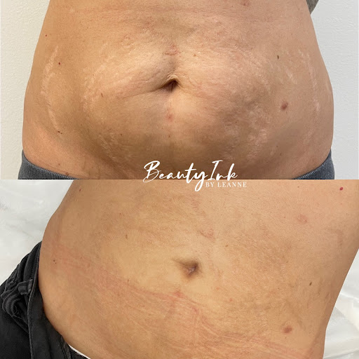 https://beautyinkbyleanne.com/wp-content/uploads/2022/07/Advanced_Stretch_Mark_Treatment_Header_Image.jpg