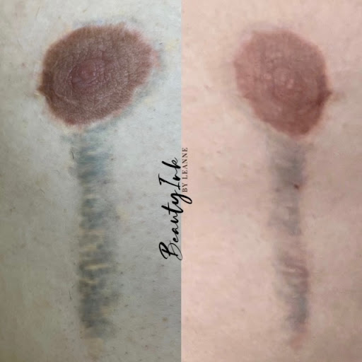 How Safe Are Non-Laser Tattoo Removal Methods? - Connecticut Tattoo Removal