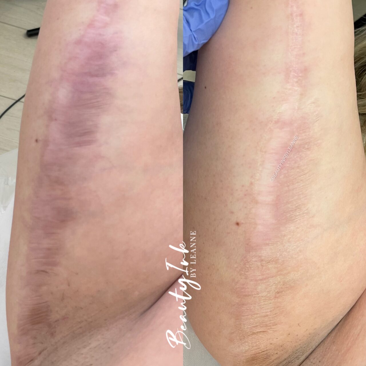 Scar and Stretch Mark Tattoo Camouflage | BeautyInkByLeanne