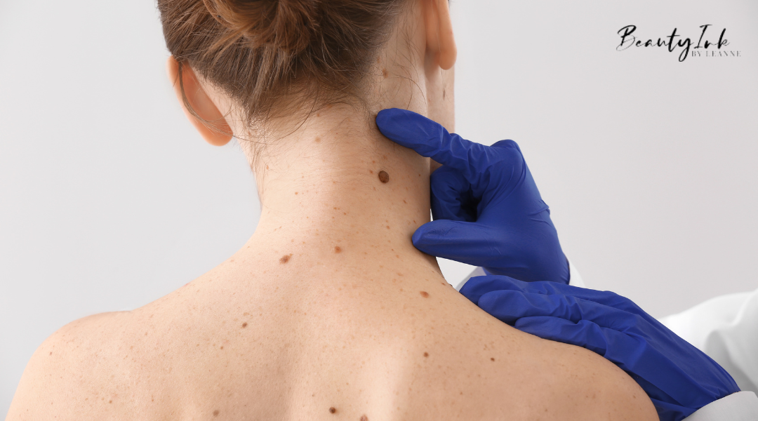 skin tag removal