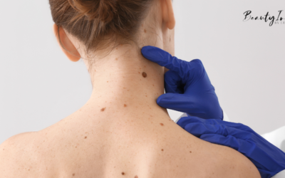Mole and Skin Tag Removal  – Why They Develop and How to Remove Them